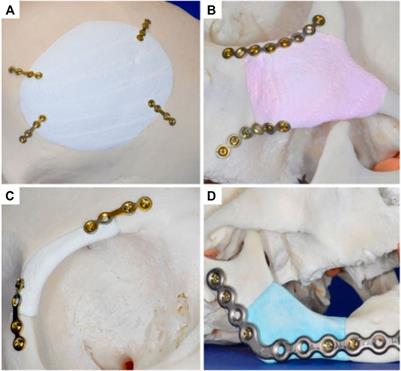 Recent Advances in Vertical Alveolar Bone Augmentation Using Additive Manufacturing Technologies